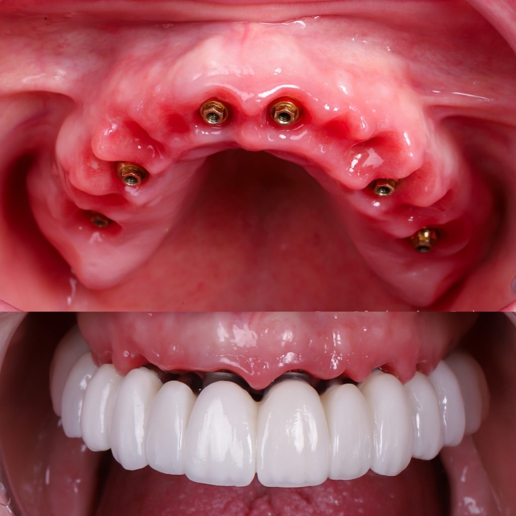 foto implantes de carga inmediata, implantes en el día