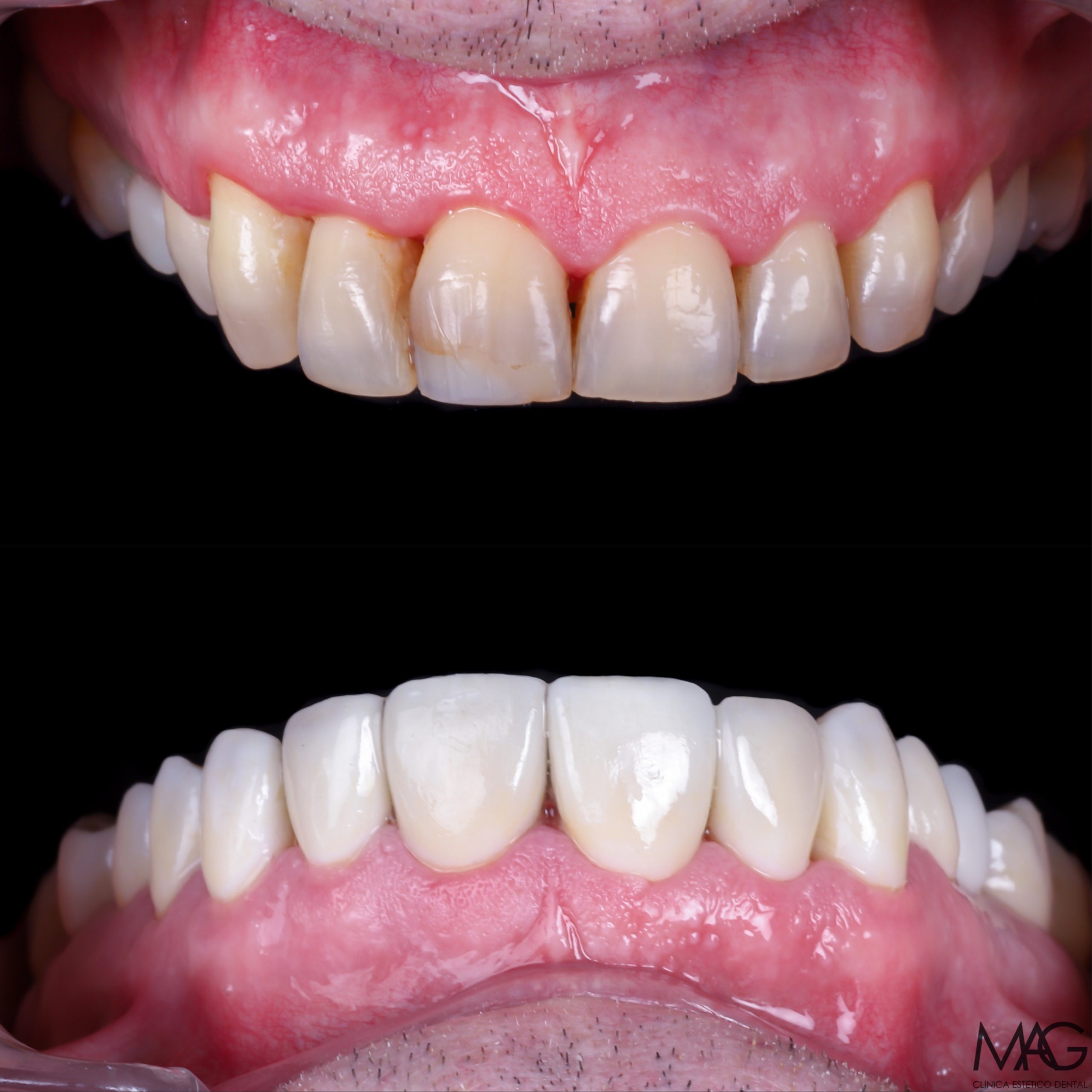 antes y despues carillas alta estética