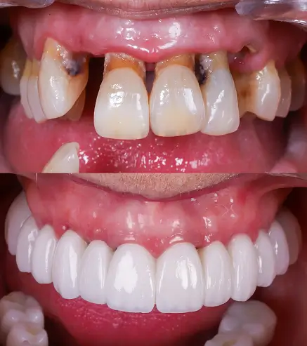 fotos antes y después implantes dentales