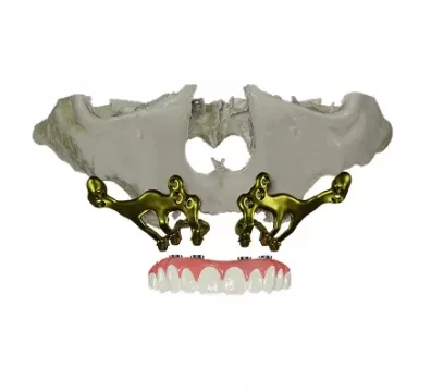 implantes subperiósticos o implantes sin tornillos para pacientes con falta de hueso