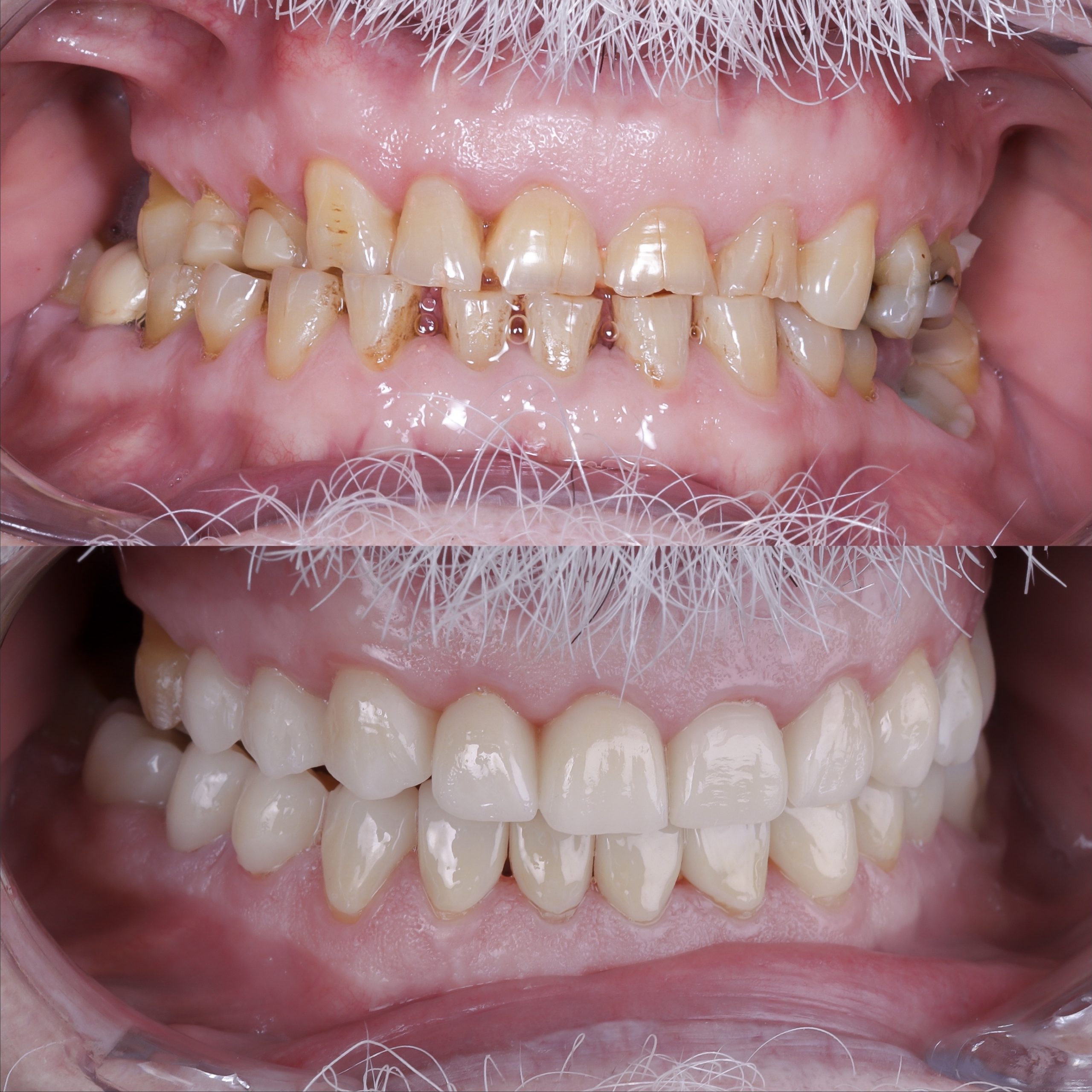 antes y después carillas bruxismo