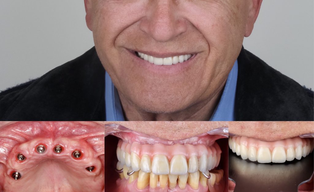 implantes dentales antes y después