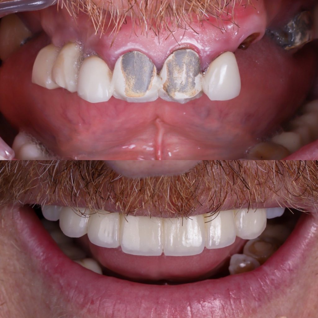 mejor clínica de implantes cigomáticos en Madrid