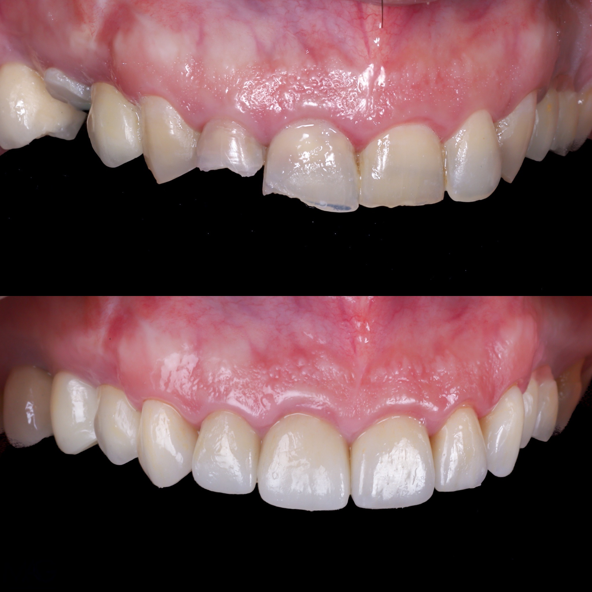 fotos reales carillas dentales