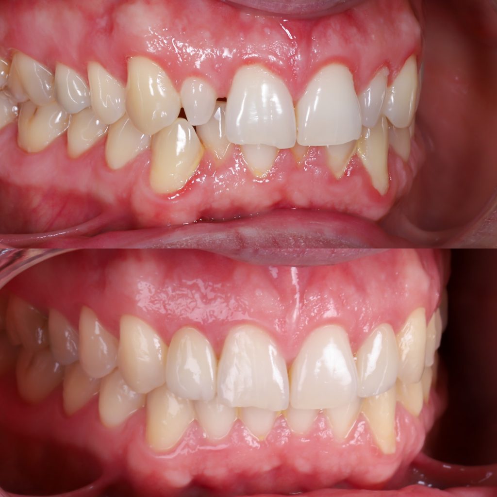 antes y después carillas dentales