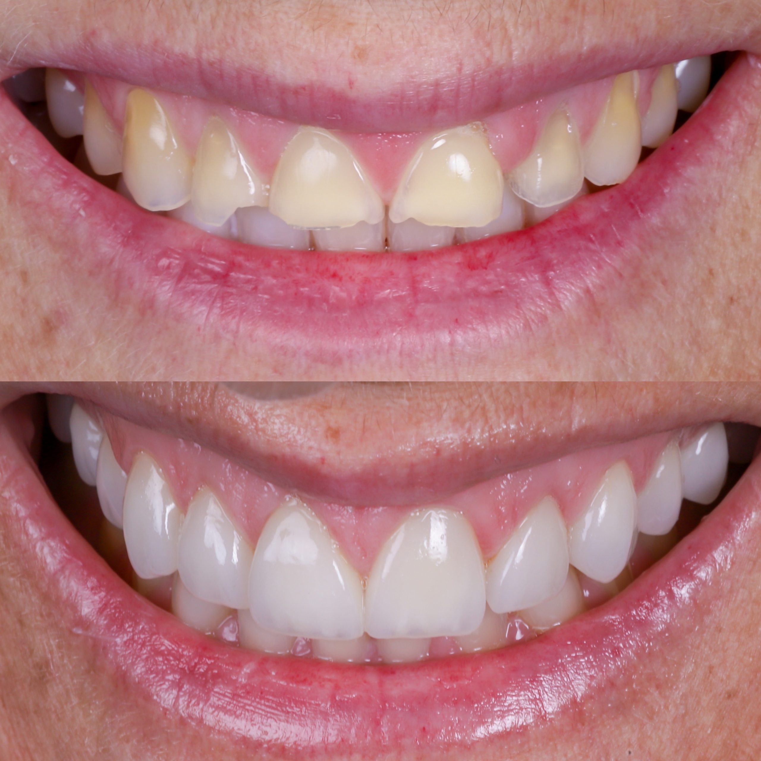 antes y depues carillas dentales caso real