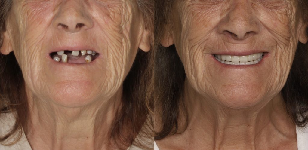implantes dentales antes y después