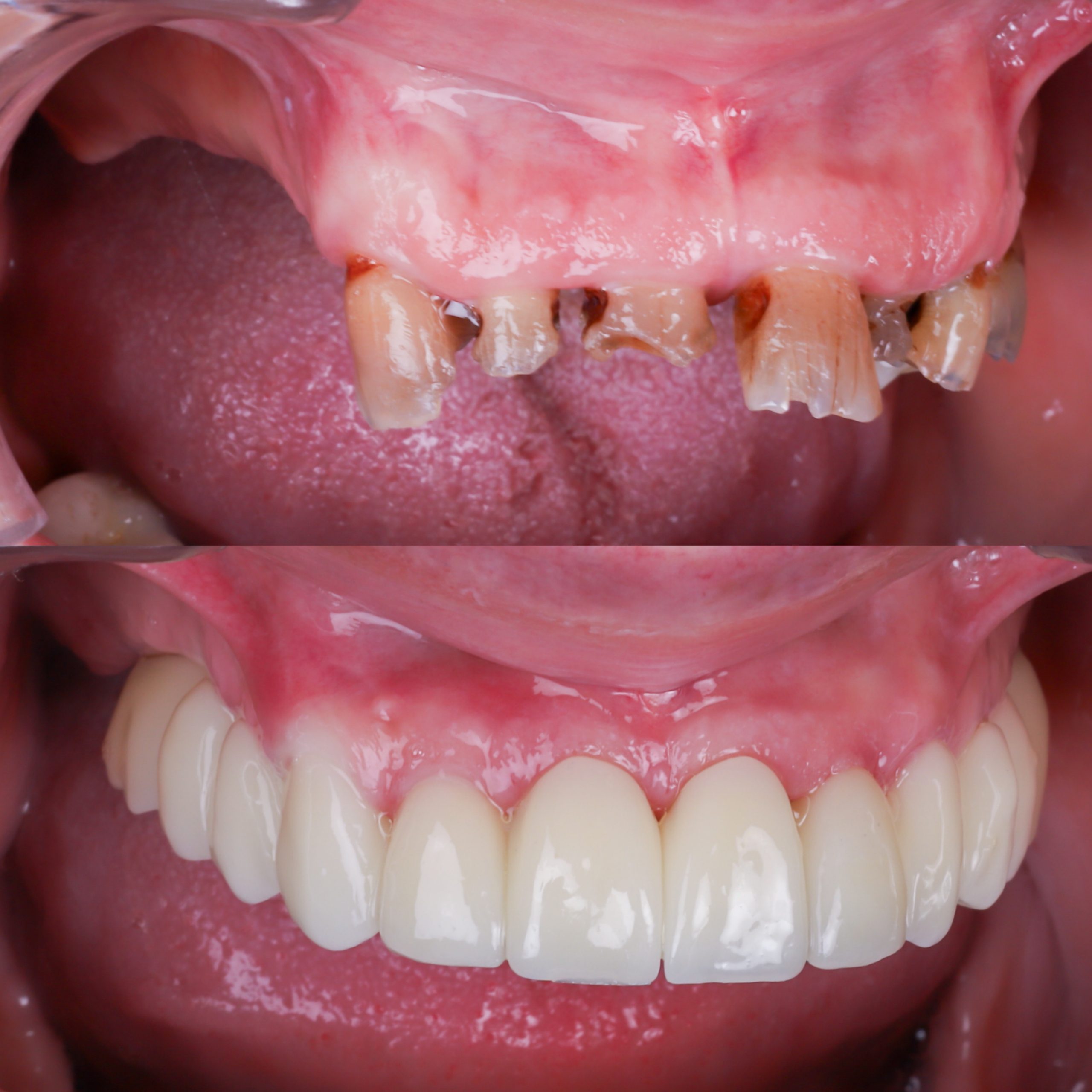 IMPLANTES DENTALES ANTES Y DESPUES