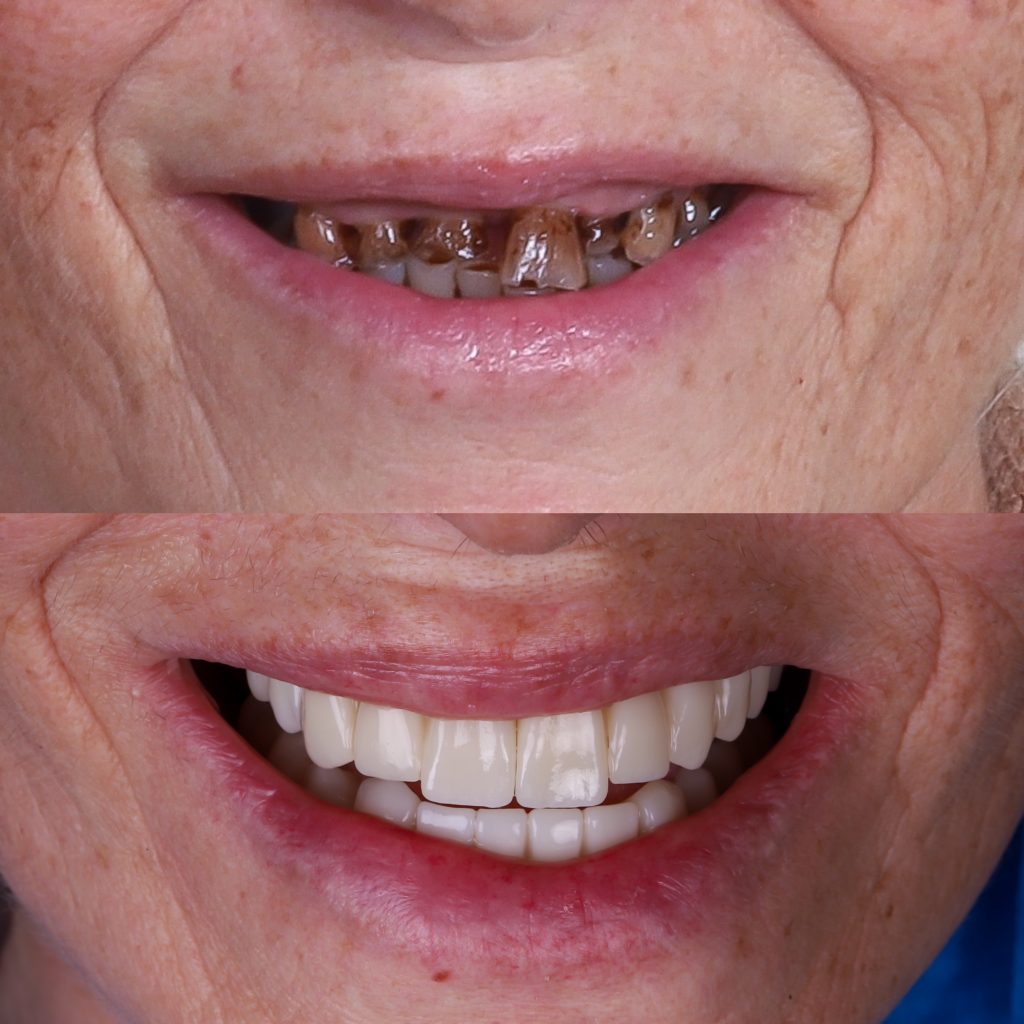 Testimonios dentadura fija sobre implantes dentales en Madrid