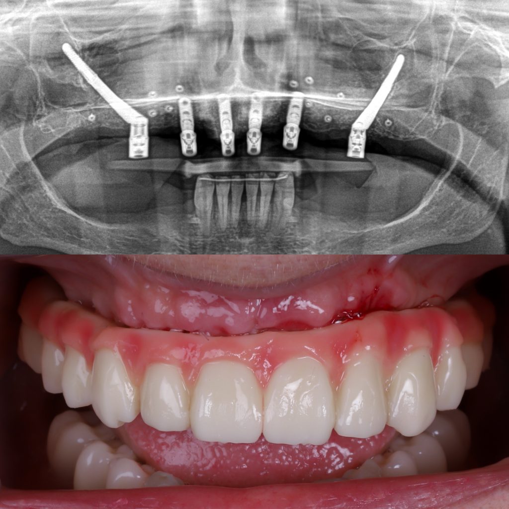 implantes sin hueso dental, implantes cigomáticos