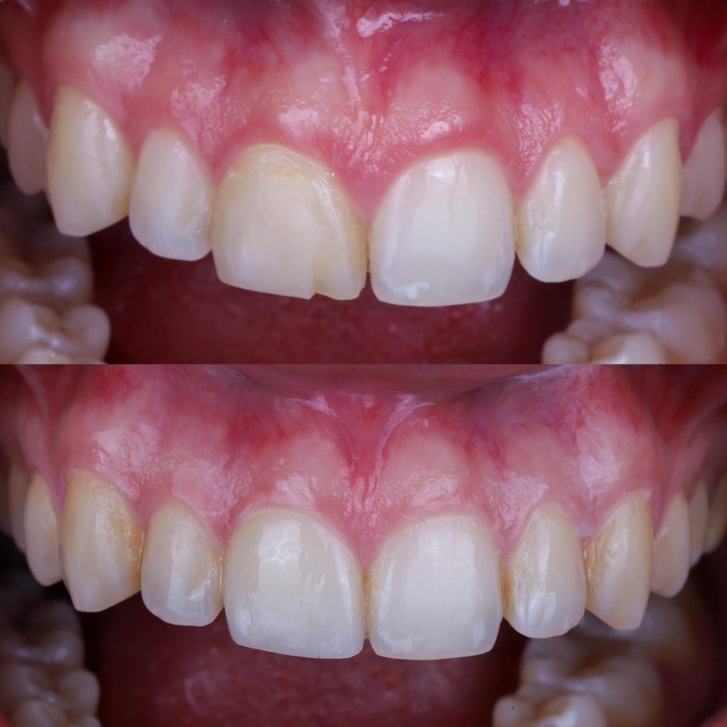 fotos carillas dentales en madrid