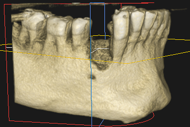 implantes-dentales-sin-hueso