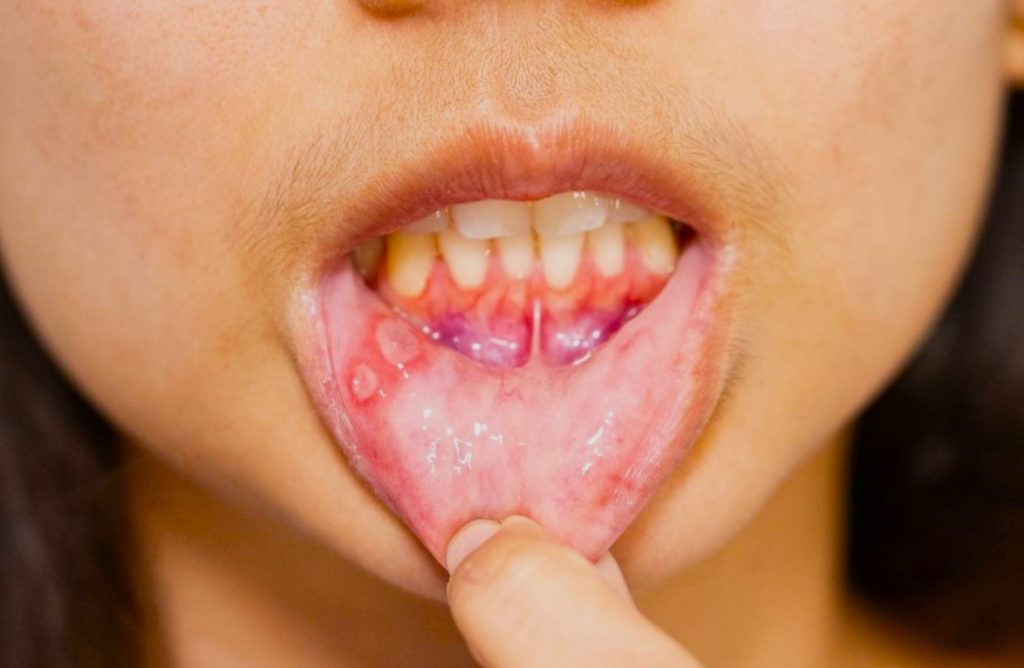 Primer plano de una boca mostrando llagas o úlceras dolorosas en el interior de los labios y alrededor de las encías