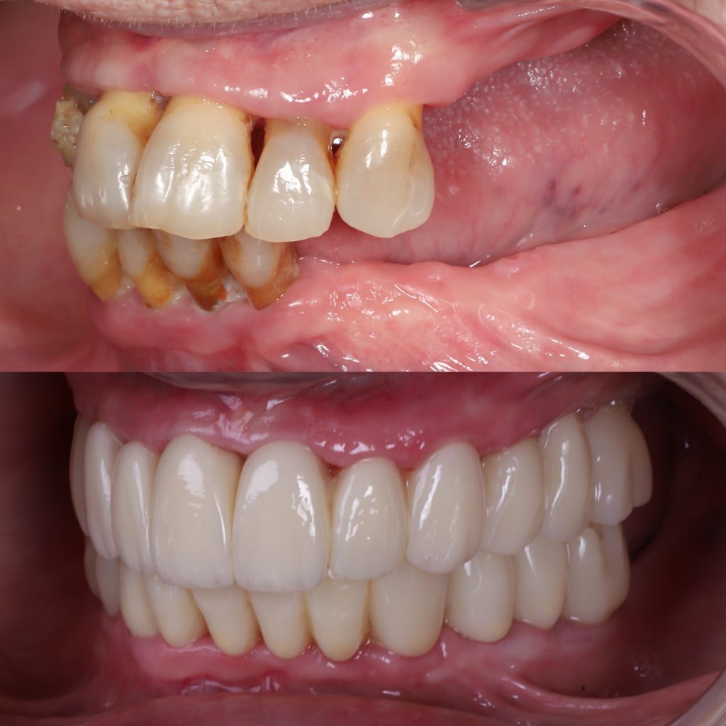 elevación seno maxilar antes y después