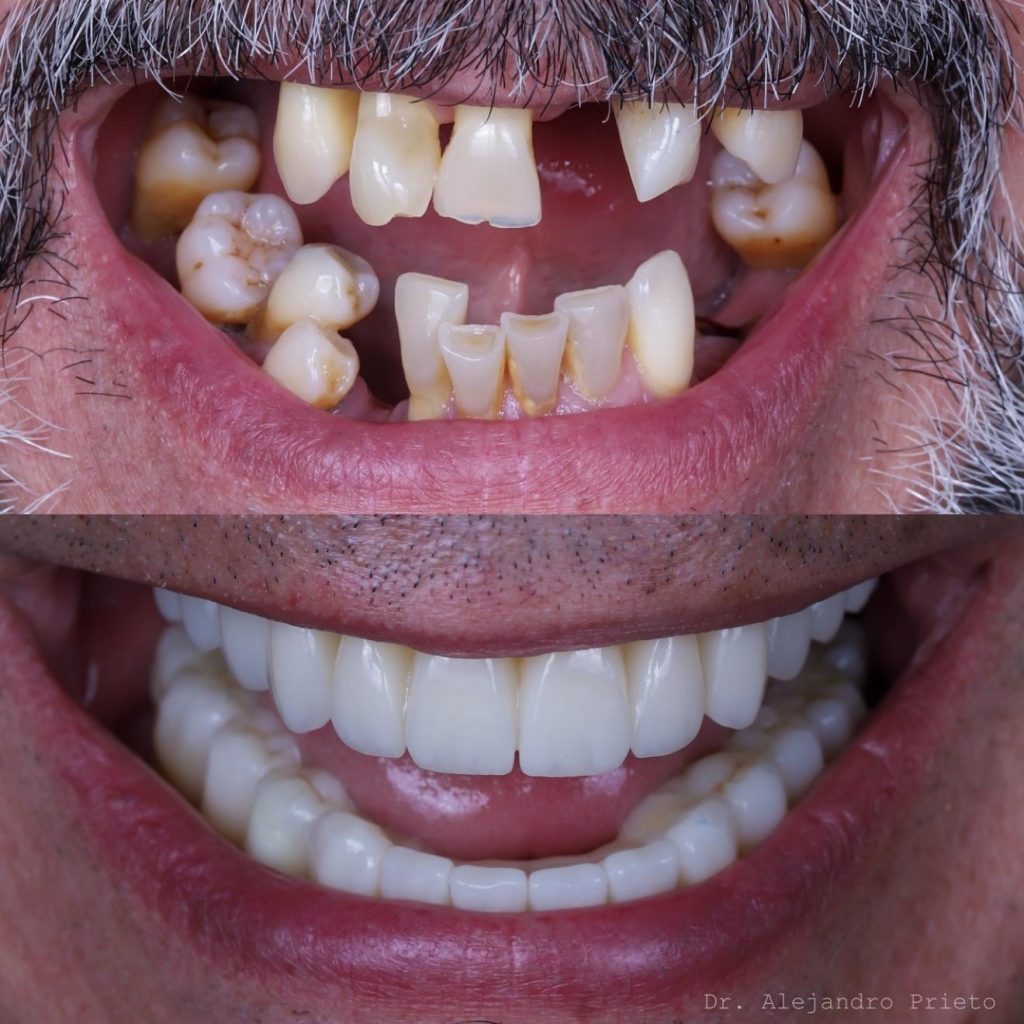antes y después implantes boca completa