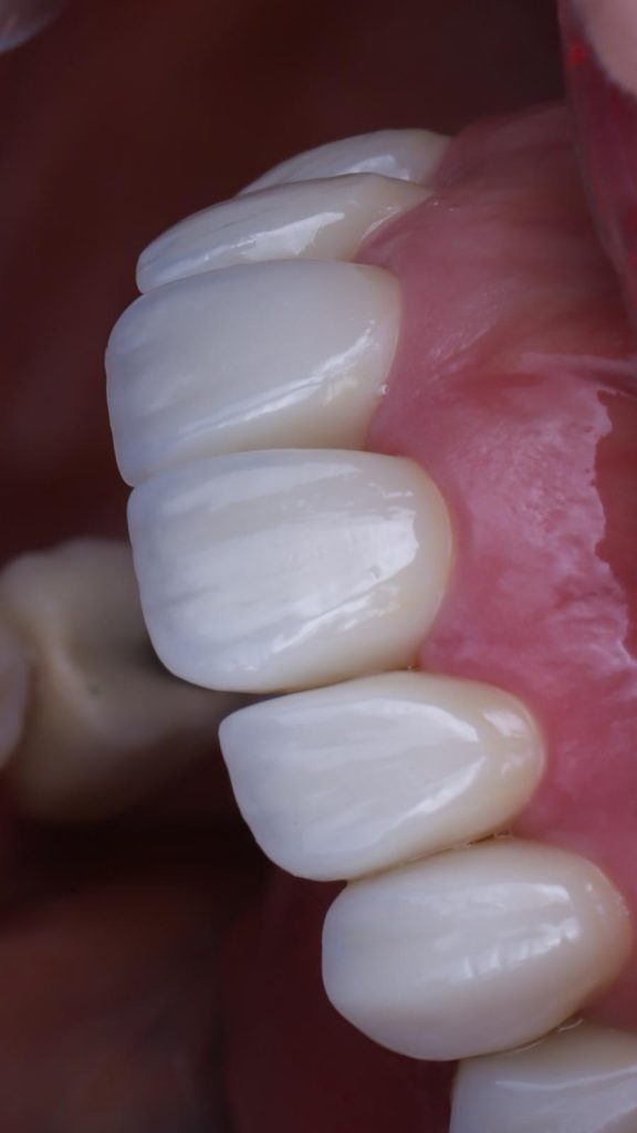 carillas porcelana en madrid
