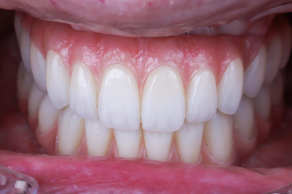 foto de caso real después de colocar implantes pterigoideos