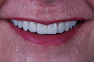 implantes transnasales foto caso real