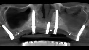 radiografía de implantes transnasales