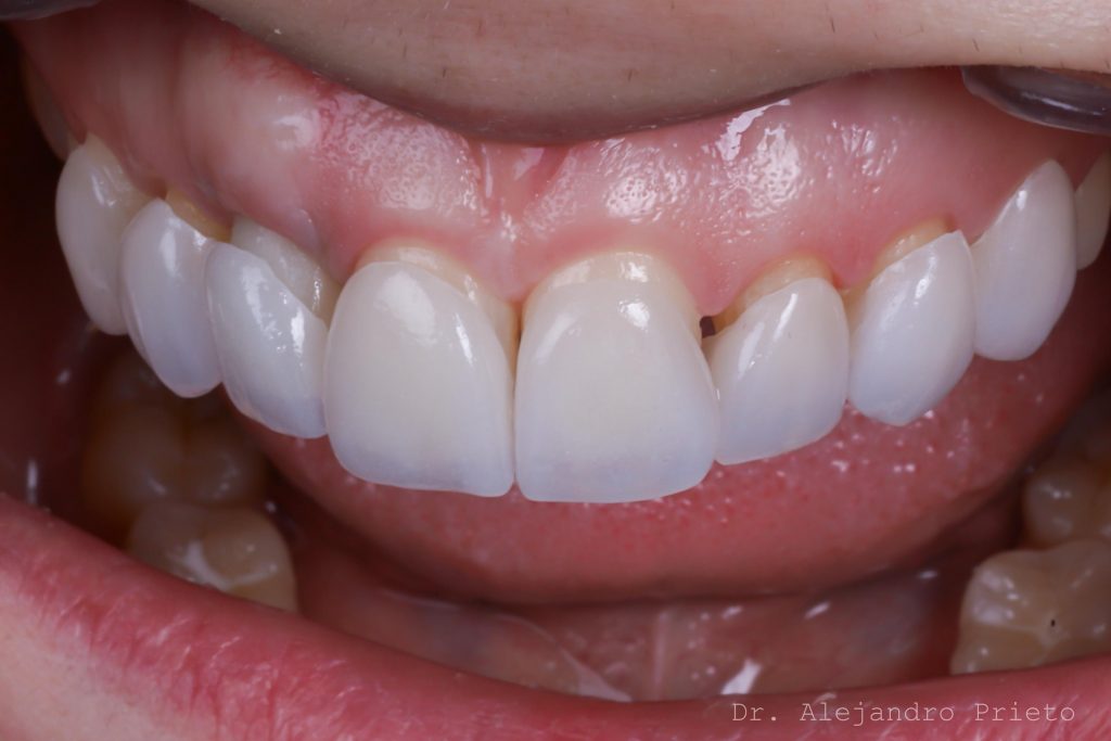 carillas dentales en barrio salamanca, madrid