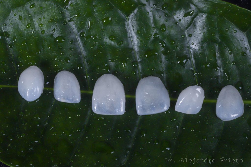 carillas dentales sin tallado