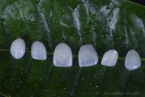 carillas dentales madrid