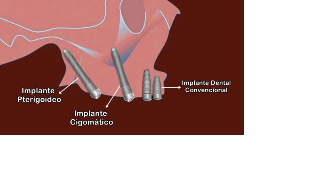IMPLANTES CIGOMÁTICOS Y PTERIGOIDEOS