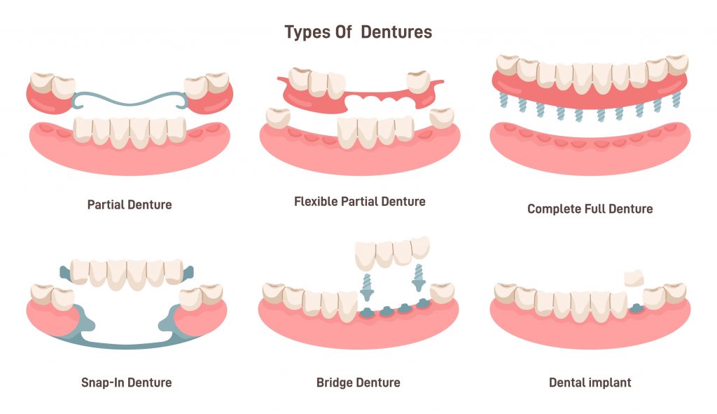 TIPOS DE IMPLANTES DENTALES