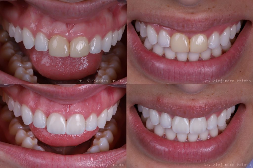carillas dentales sin tallado fotos antes y después