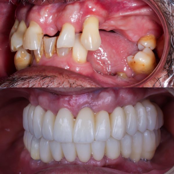 tratamiento de elevacioón de seno maxilar en madrid